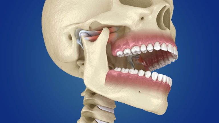 Lire la suite à propos de l’article BRUXISME