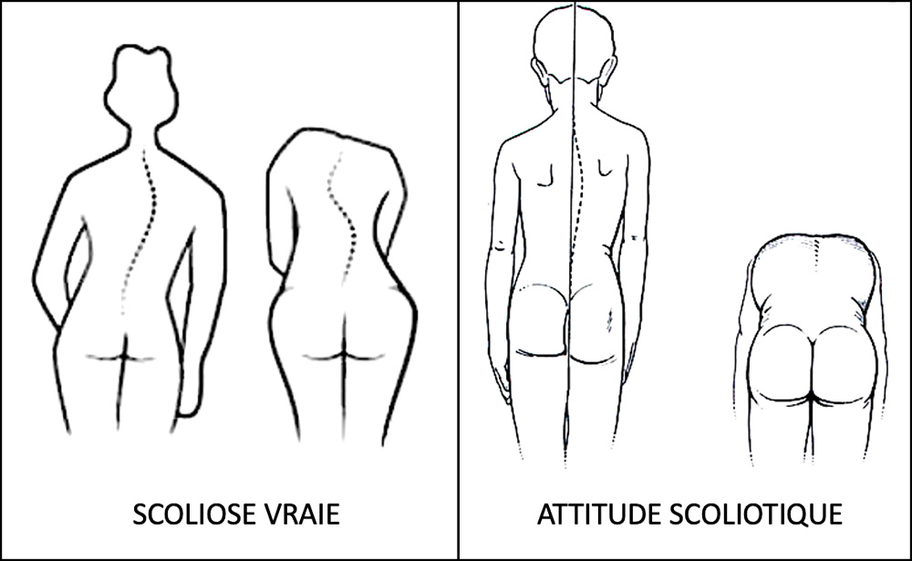 scoliose-vraie-et-attitude-scoliotique